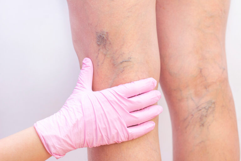 Female legs with varicose veins. At the doctors surgeons appointment. doctors hands in gloves. Concept of human health and disease. Vascular diseases, problems of varicose veins